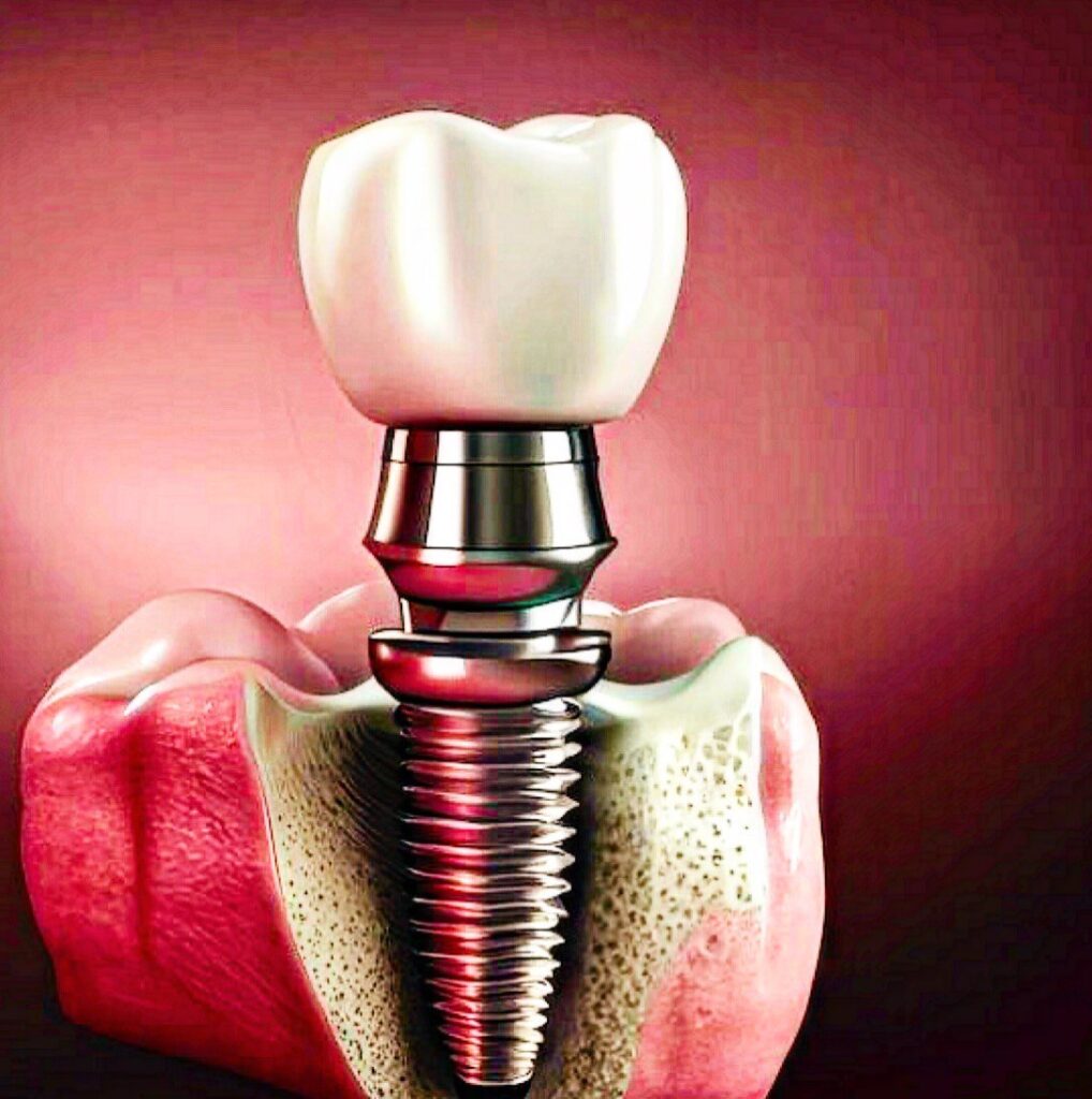 Імплантація зубів: що таке, як обрати