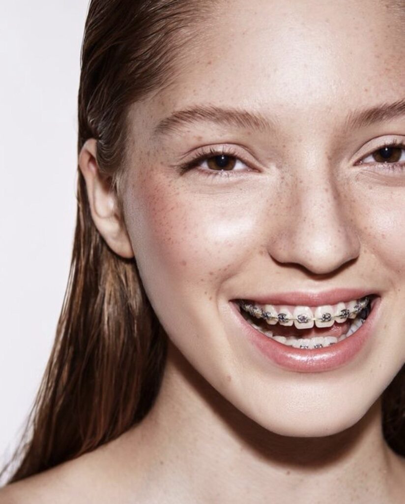 Брекети – встановлювати чи ні?
